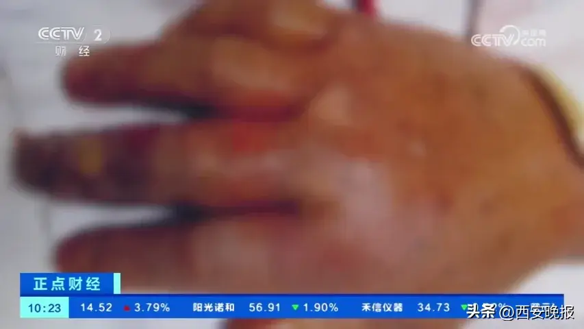 索赔22万！女子超市买鱼被刺八级伤残，每天得剜去腐肉，法院判了→-图11